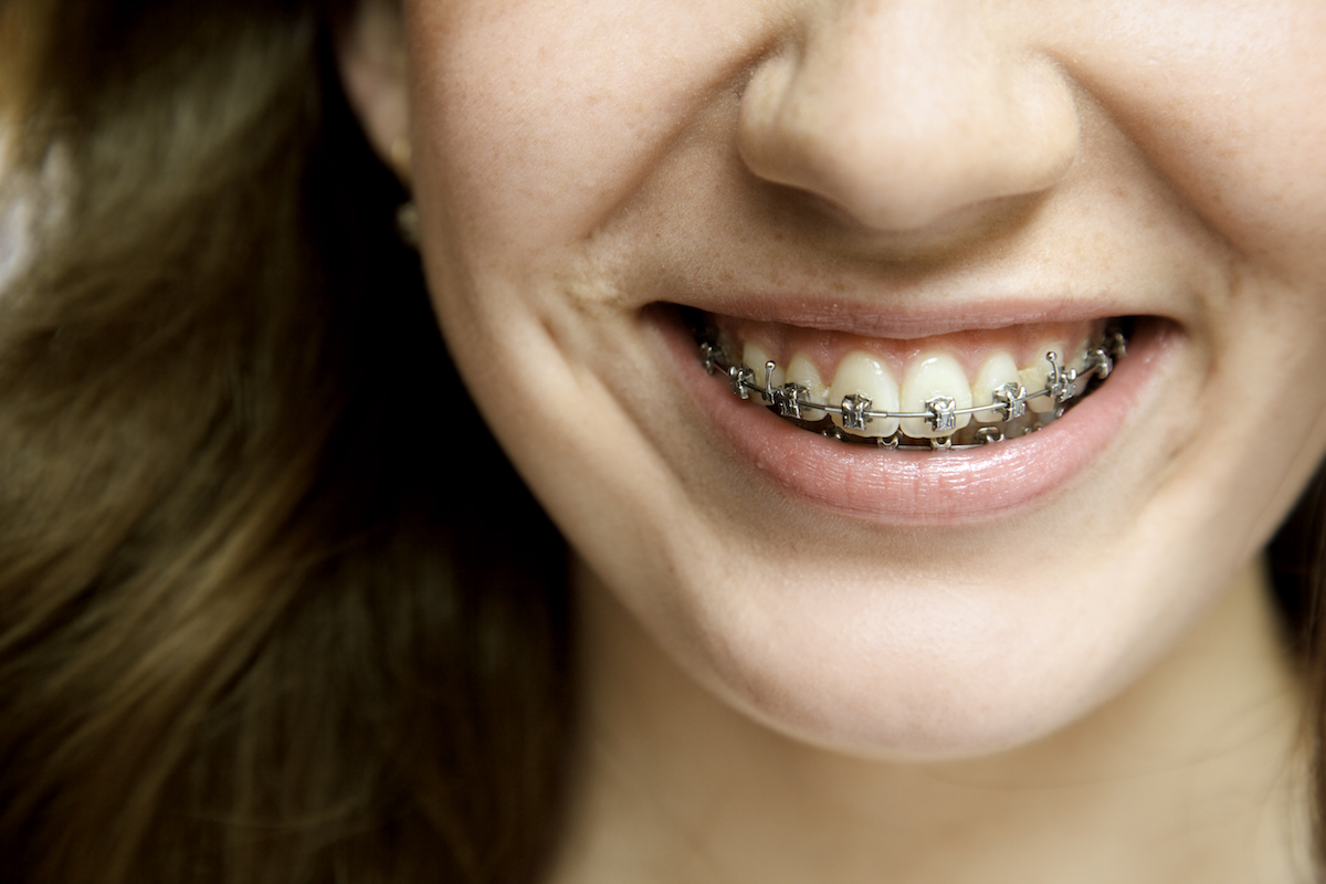 Young woman wearing dental braces.